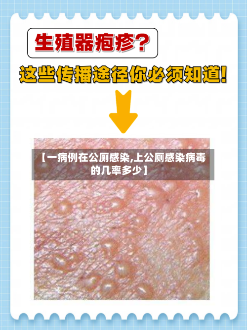 【一病例在公厕感染,上公厕感染病毒的几率多少】