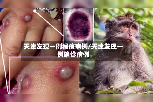 天津发现一例猴痘病例/天津发现一例确诊病例