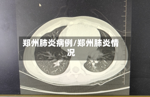 郑州肺炎病例/郑州肺炎情况